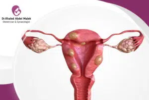 هل استئصال الرحم يسبب زيادة الوزن؟ 2 عملية استئصال الورم الليفي خارج الرحم