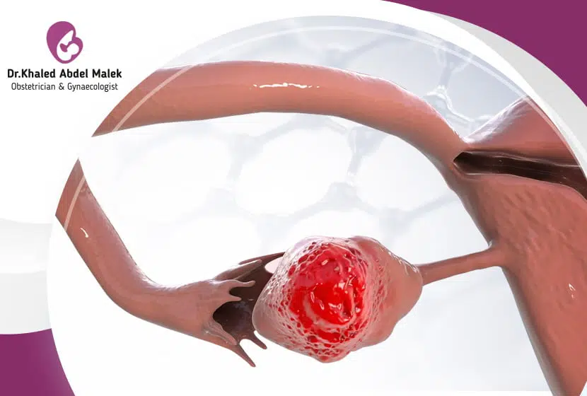 اعراض التهابات الرحم والمبايض