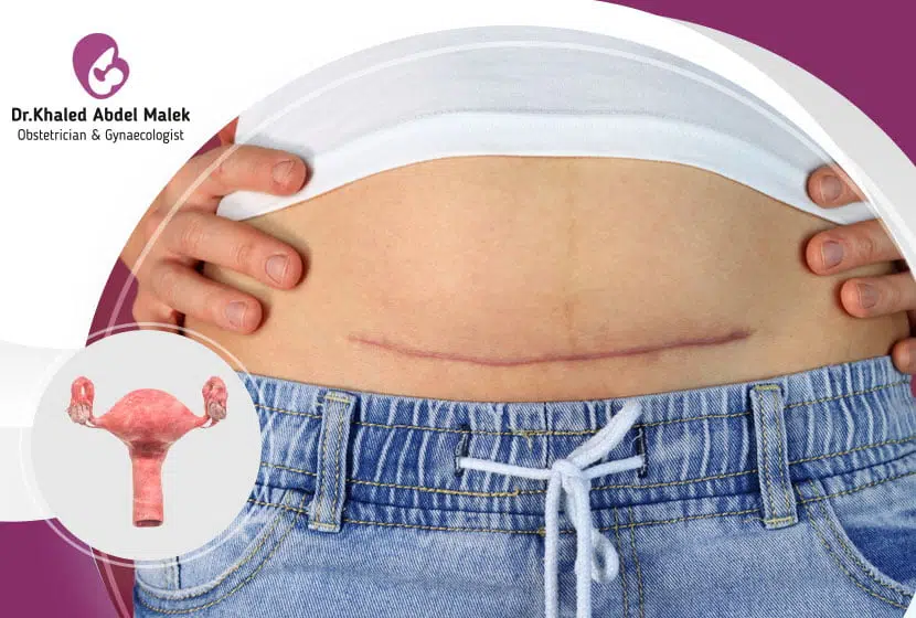 ماذا بعد عملية استئصال الرحم